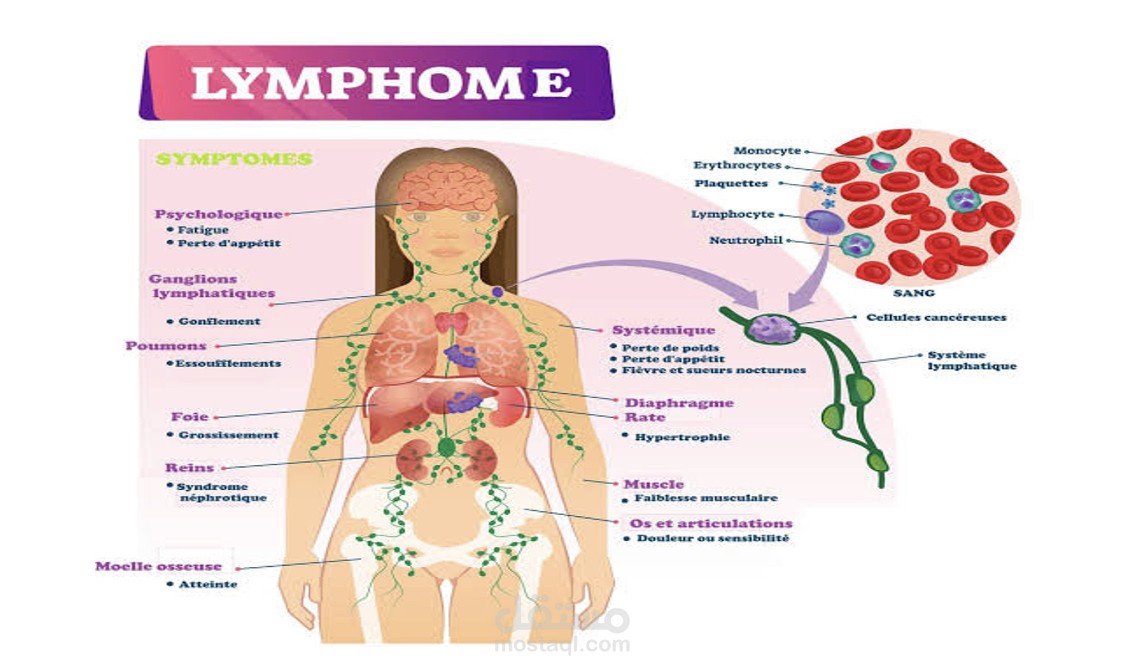 سرطان الجهاز اللمفاوي/ اللمفوما
