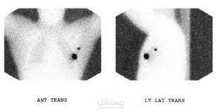 التصوير الومضاني اللمفاوي Lymphoscintigraphy