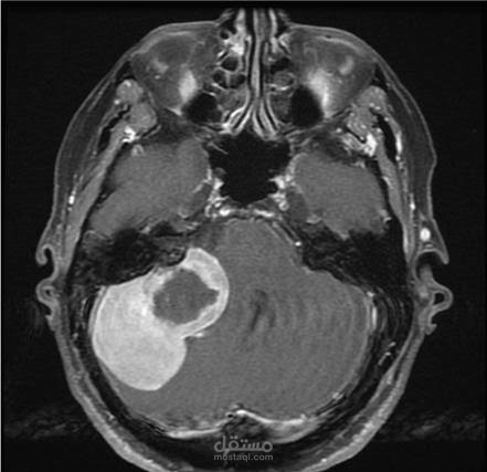 brain_tumor