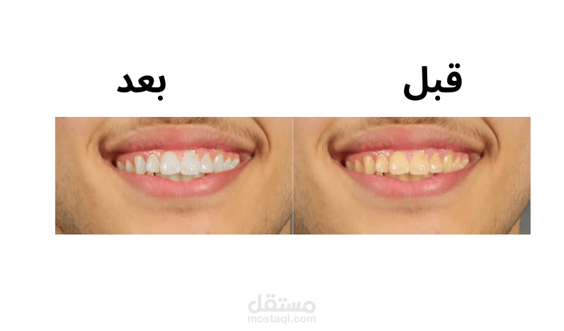 تبييض الأسنان في الصور
