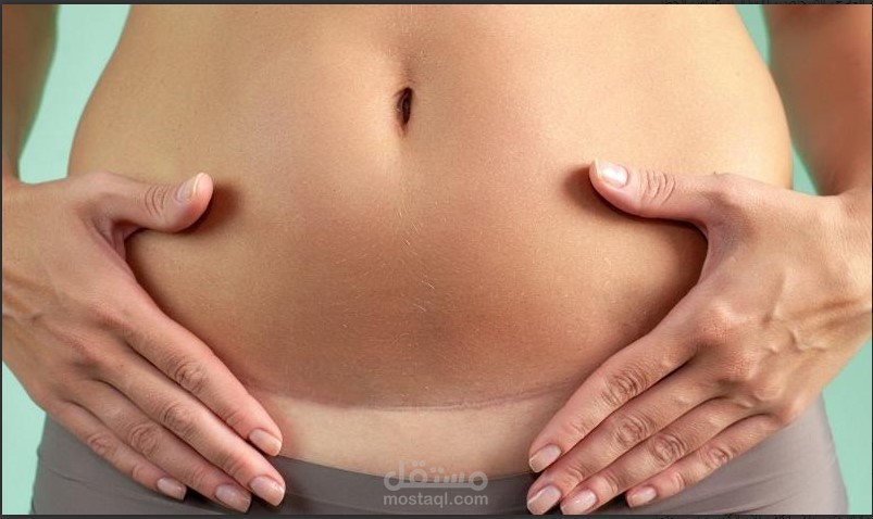 مقالة طبية عن الخياطة التجميلية بعد اولادة