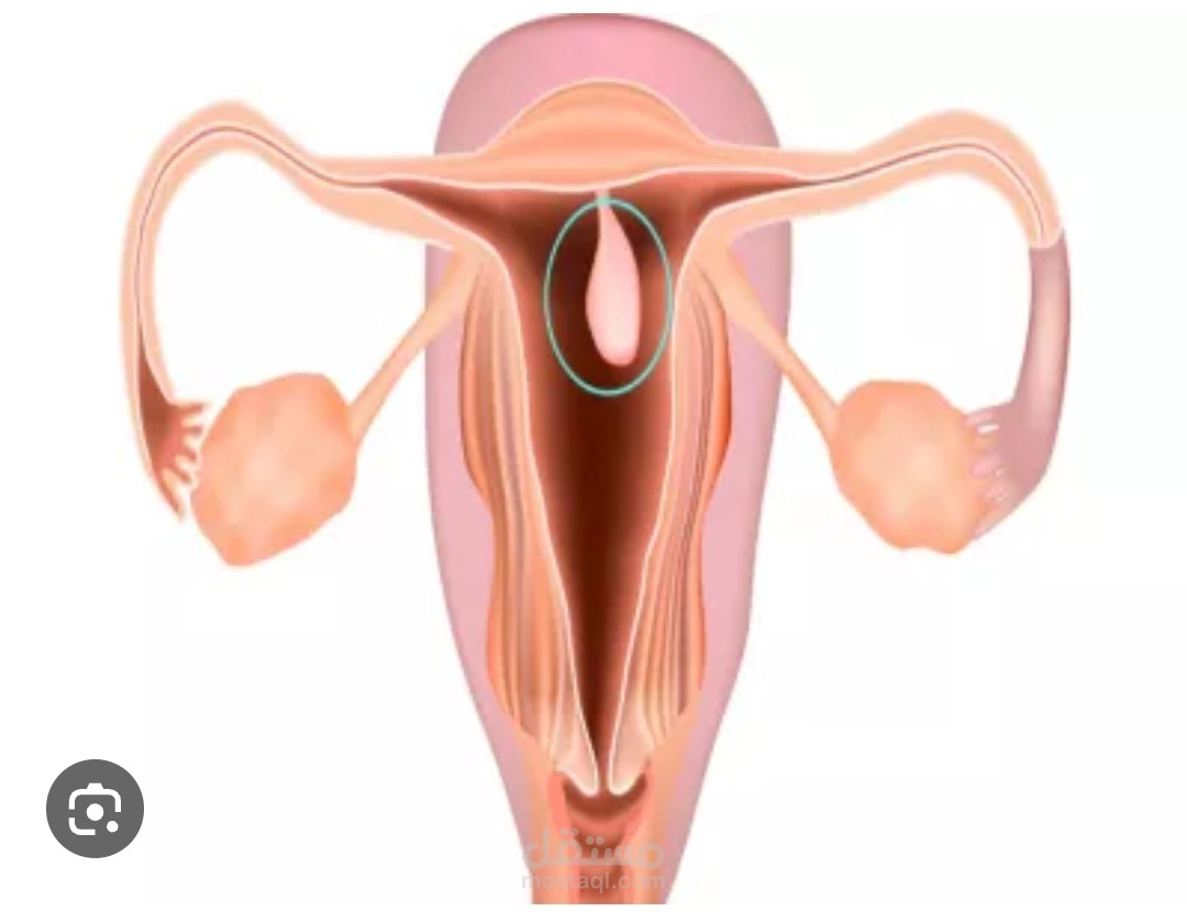 كتابة محتوى طبي عن  لحمية الرحم  endometrial polyp