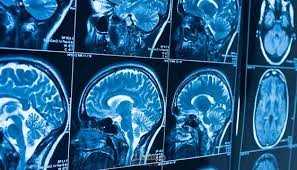 Brain Tumor: AI-Powered MRI Tumor Classification