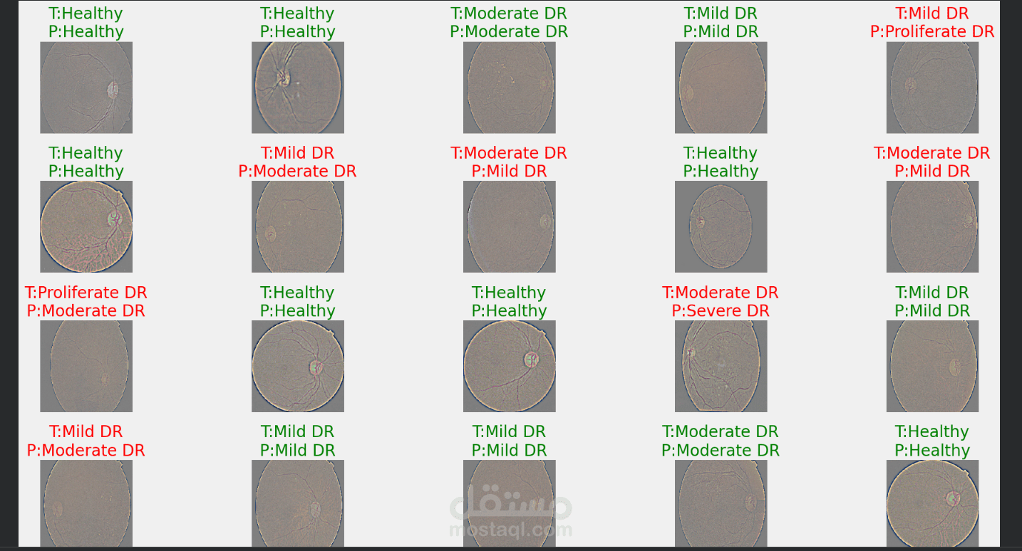 تطوير نموذج ذكاء اصطناعي لتشخيص اعتلال شبكية العين السكري بدقة عالية