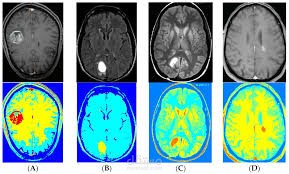 Computer Vision to detect brain tumor