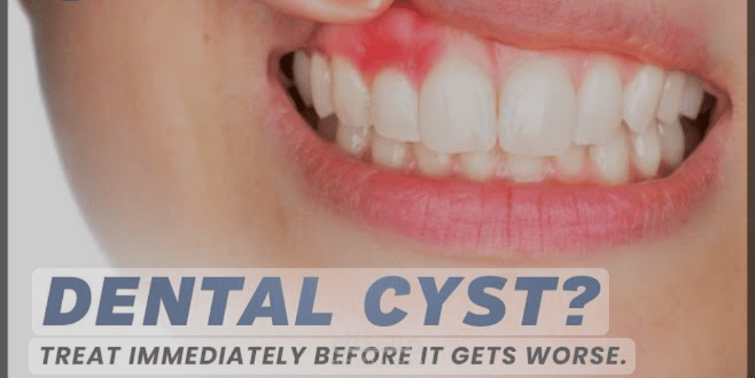 cysts