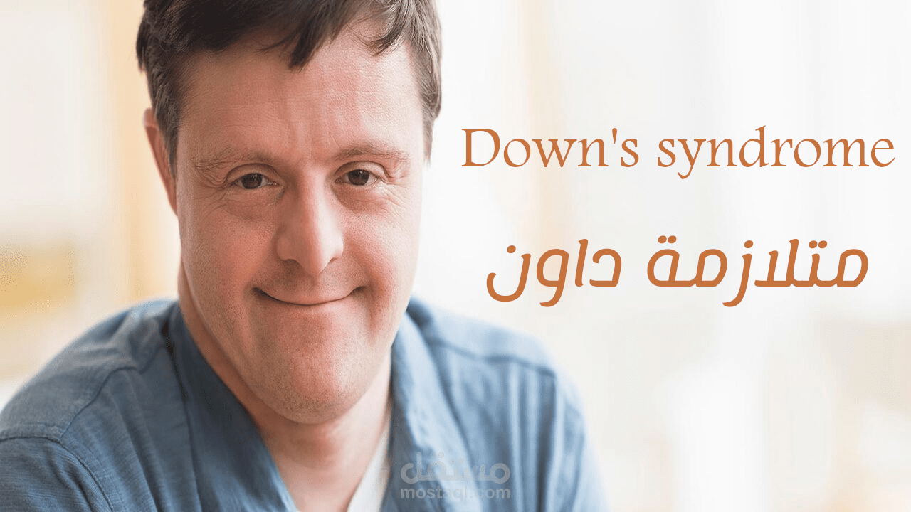 متلازمه داون