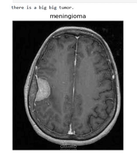 Brain tumor classifier using advanced Machine learning