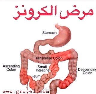 داء كرون