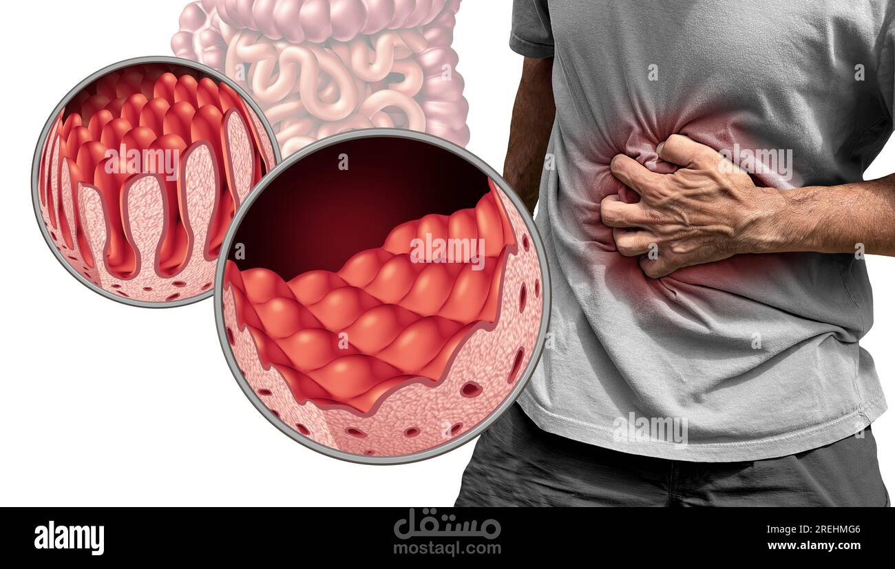 مقال طبي عن السيلياك