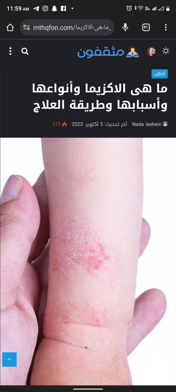 ما هى الاكزيما وأنواعها وأسبابها وطريقة العلاج