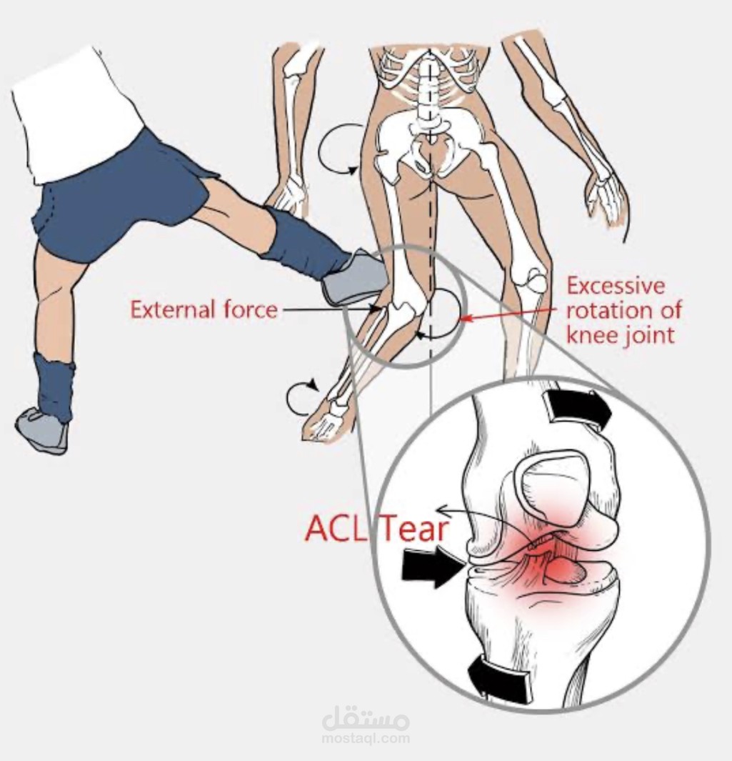 Anterior cruciate ligament injuries in football players
