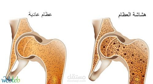 بحث طبي عن هشاشة العظام