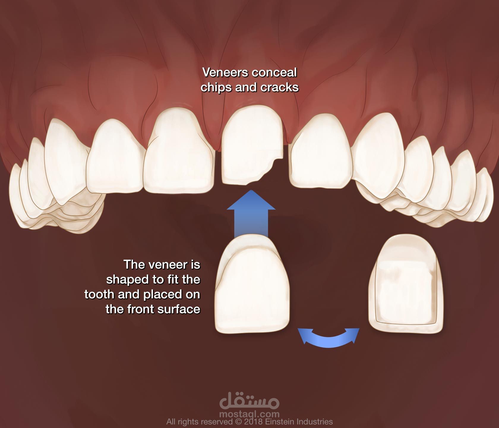 what are veneers