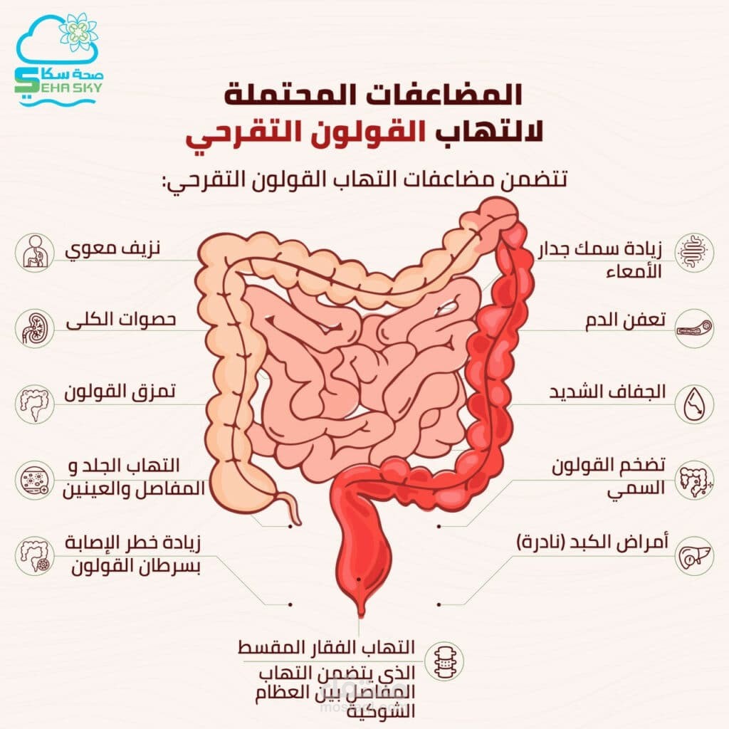التهاب القولون التقرحي