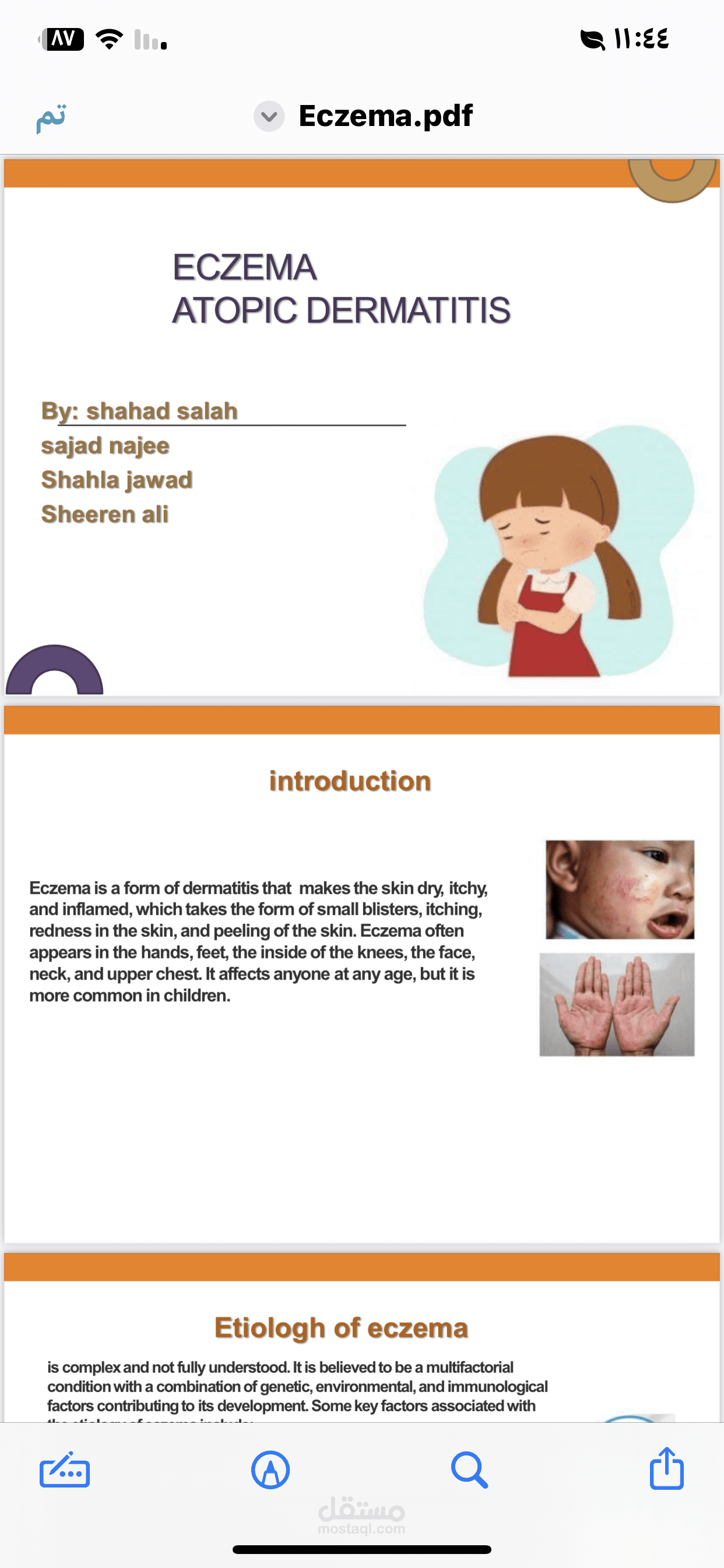 ECZEMA ATOPIC DERMATITIS