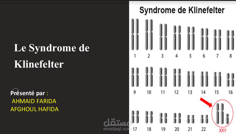 Syndrome de klinfelter