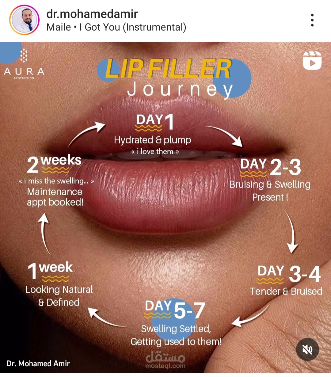 Filler journey عيادة د.محمد أمير