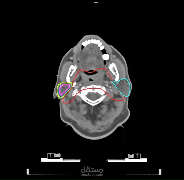 Designing the best treatment plan for patients with nasopharyngeal carcinoma treated with SIB-VMAT using the MONACO treatment planning system