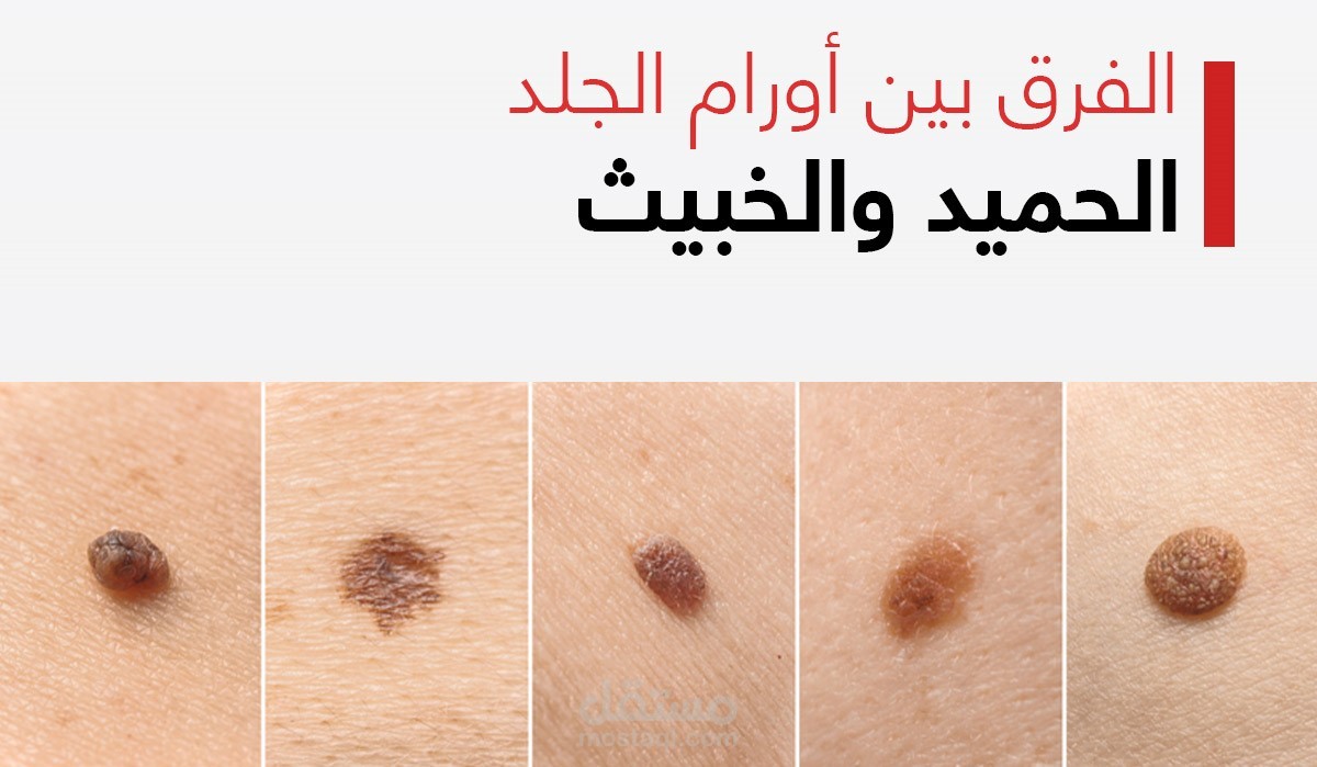 نموذج تعلم عميق لتشخيص سرطان الجلد باستخدام EfficientNet-B0 يستخدم الصور والعمر والجنس والموقع التشريحي