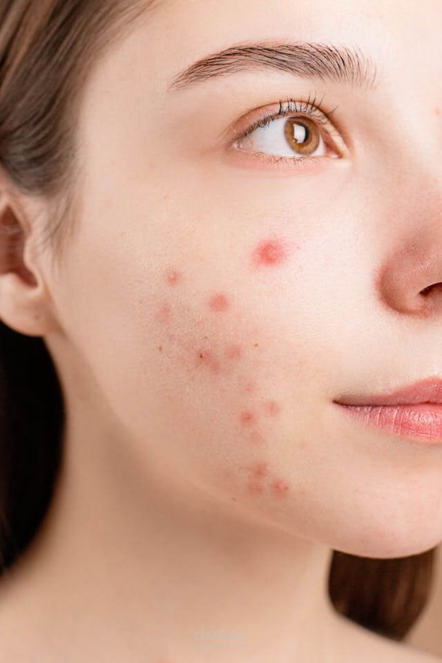 Pregnancy pimples on face causes symptoms and treatments