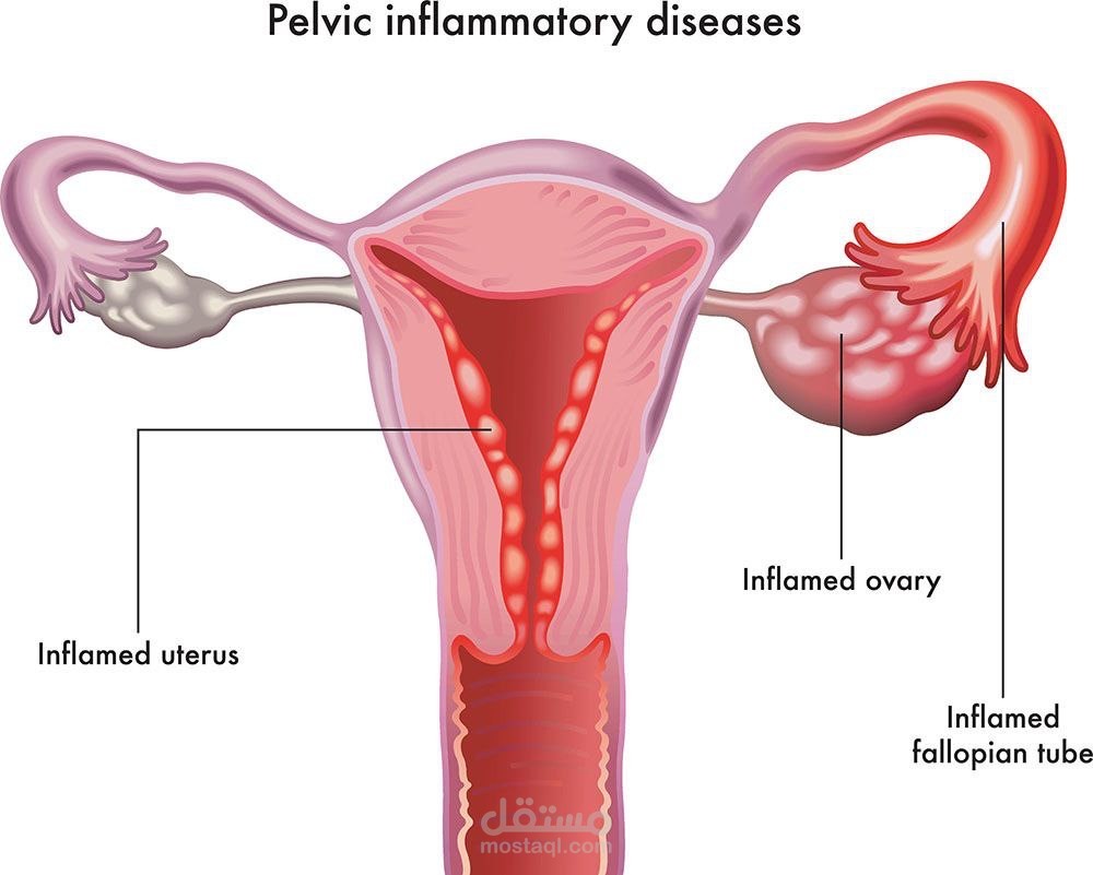 Pelvic Inflammatory Disease Medication | 5 Ways To Prevent