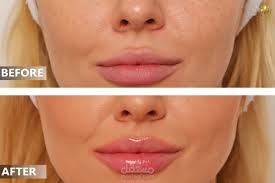 The Best dermal filler injections in Dubai