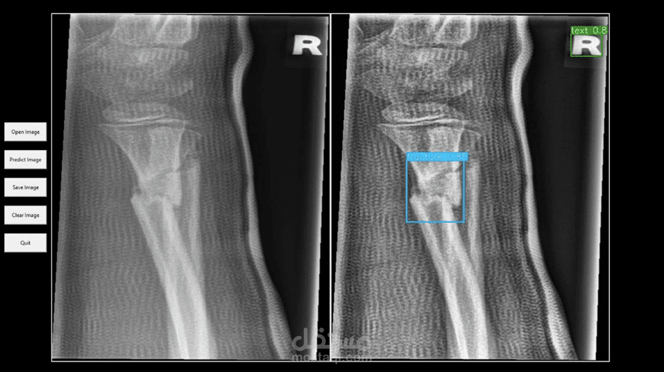 Bone Fracture Detection