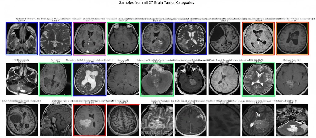 نظام ذكاء اصطناعي لتصنيف أورام الدماغ