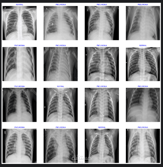 تشخيص مرض الالتهاب الرئوى من خلال صور x-ray