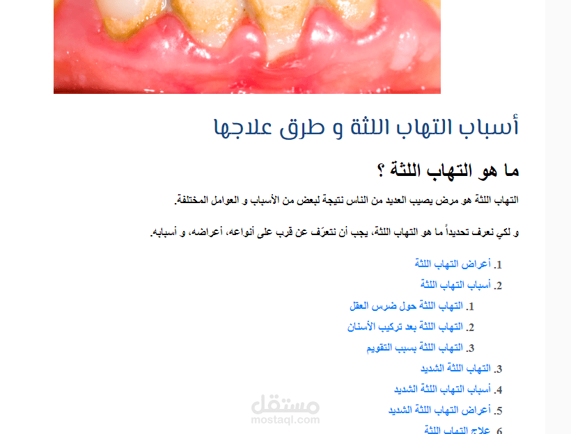 كتابة مقال عن التهاب اللثة