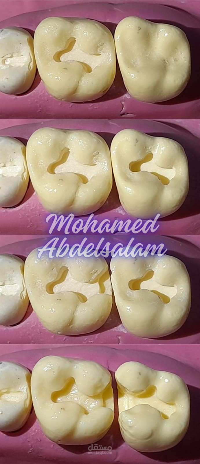 ابراز قوة قبل وبعد اجراءات طب الأسنان