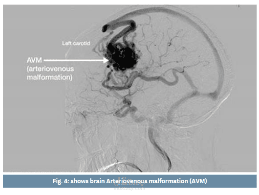 Pages of a review article about " Arterio-venous malformation"
