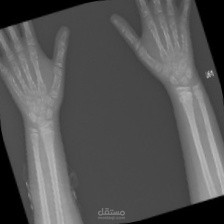 Bone  X-ray