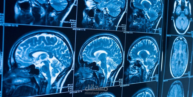 اكتشاف ورم الدماغ