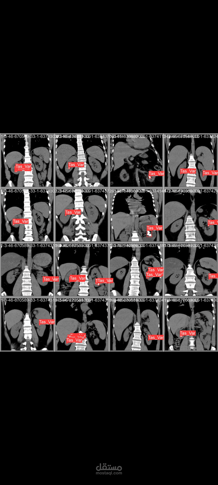 Kidney stones detection using yolov9