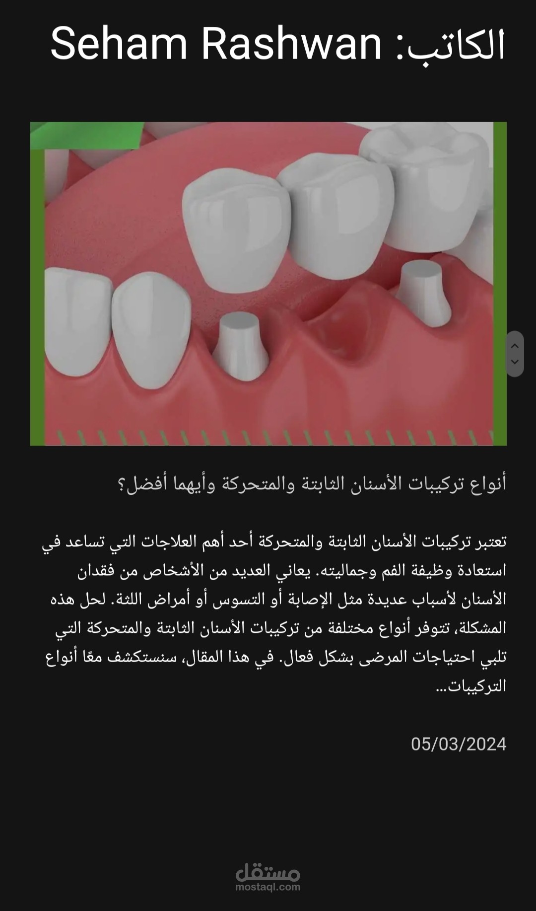 أنواع تركيبات الأسنان الثابتة والمتحركة وأيهما أفضل