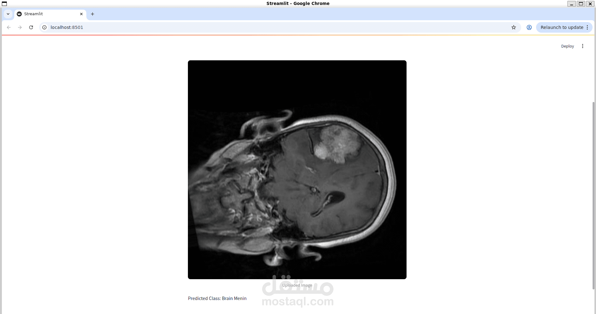 تصنيف اورام المخ