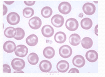 Anemia