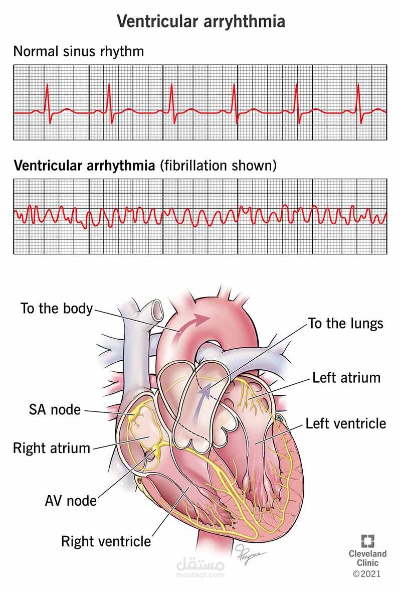 Ventricular arrhythmia
