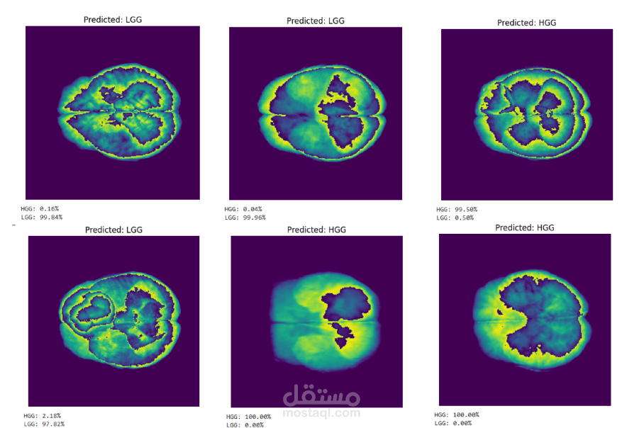 Classification of celebral Gliomas (HGG,LGG) based on MRI using deep learning