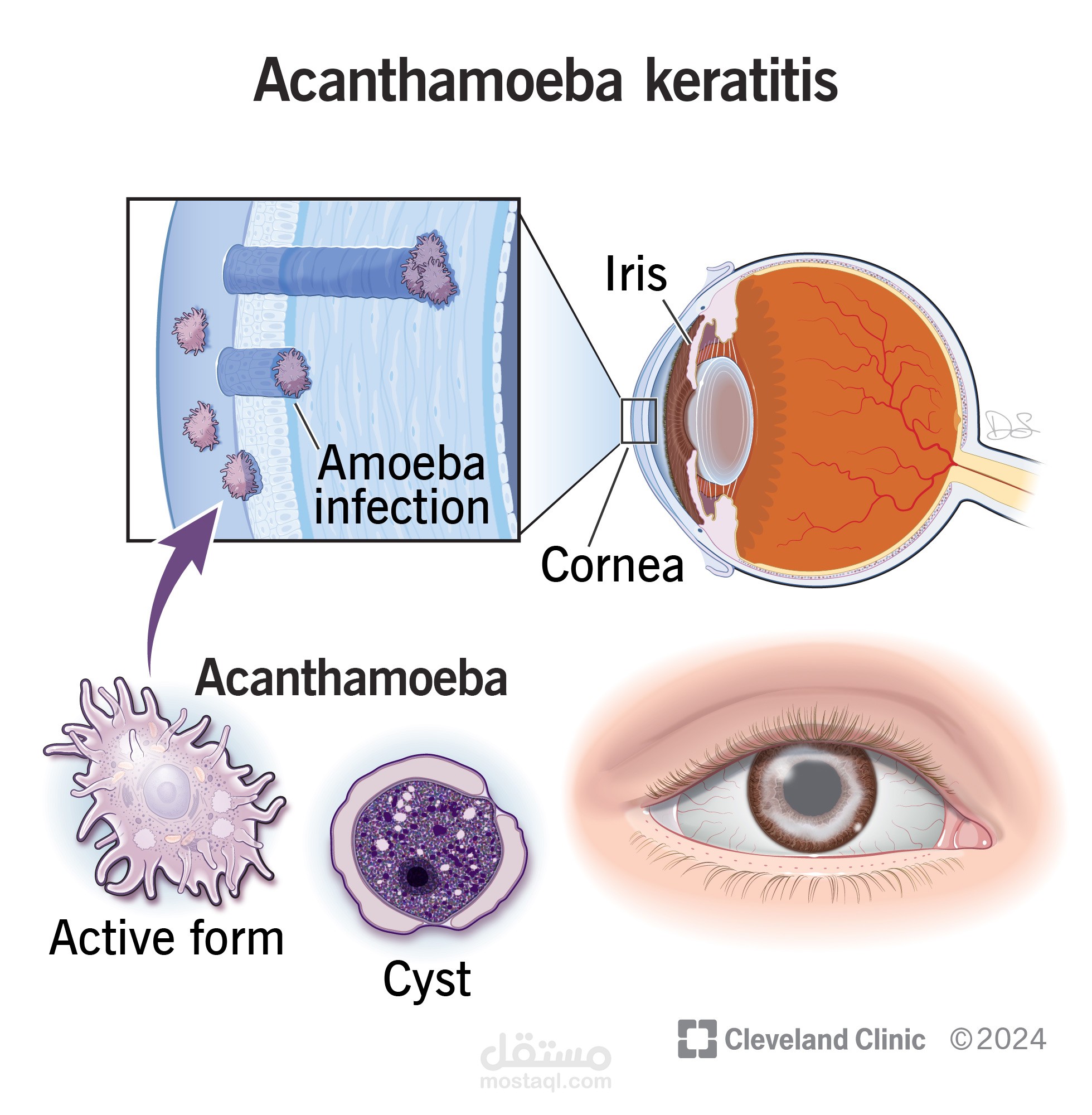 SEMINAR  for Acanthamoeba keratitis associated with contact lens wear