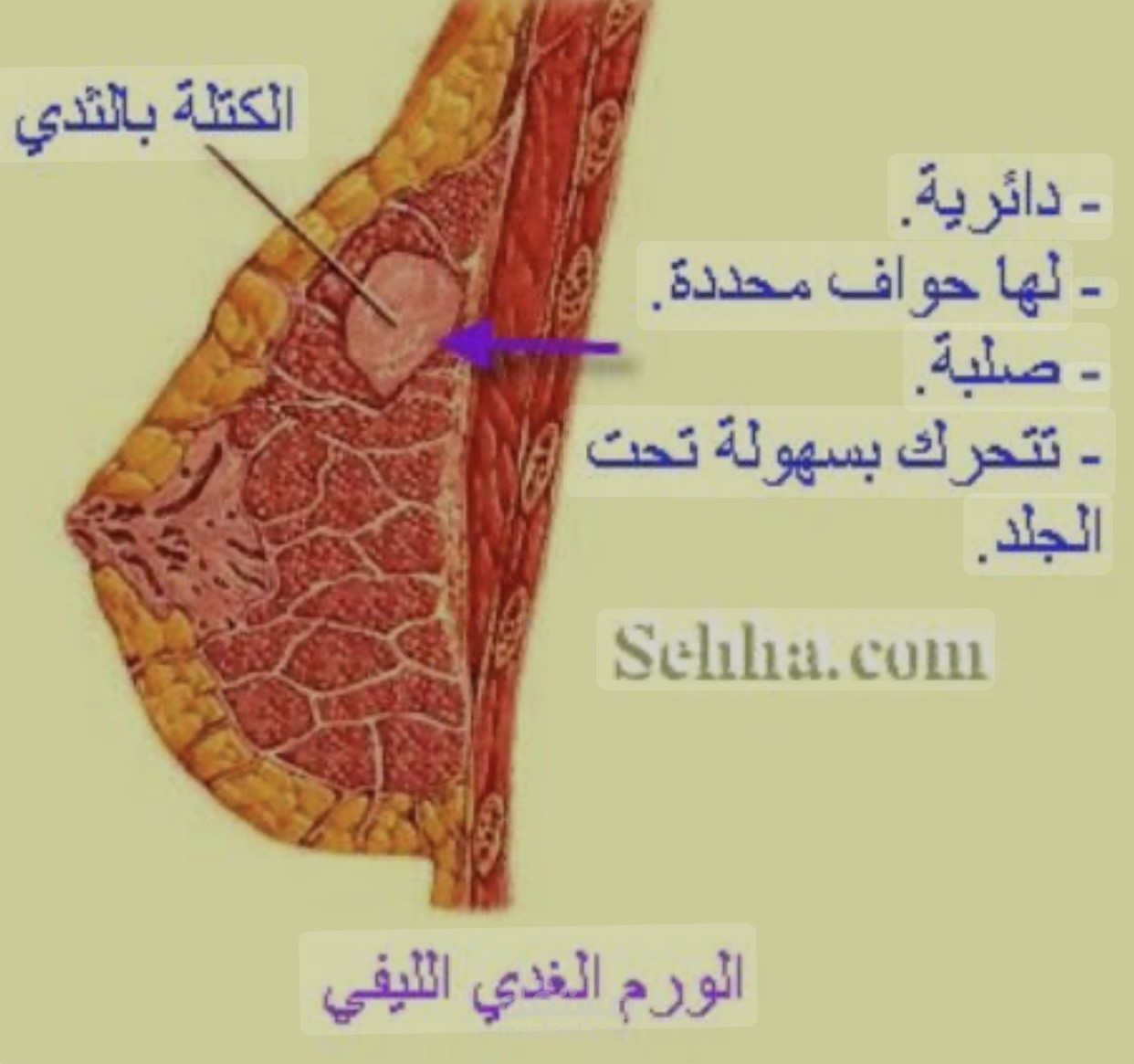 مقال مختصر عن الورم الغدي الليفي