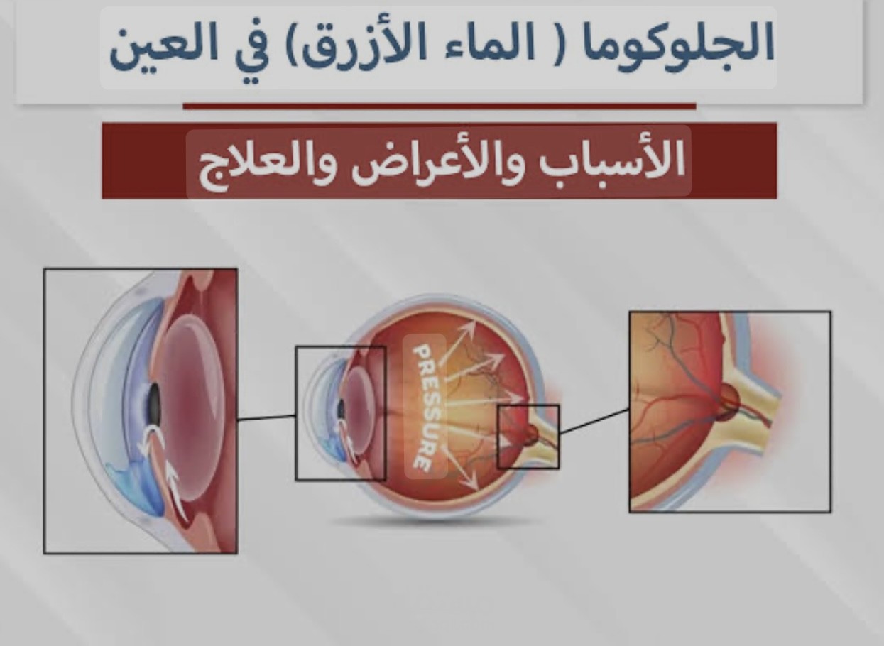 بوستر عن مرض المياه الزرقاء