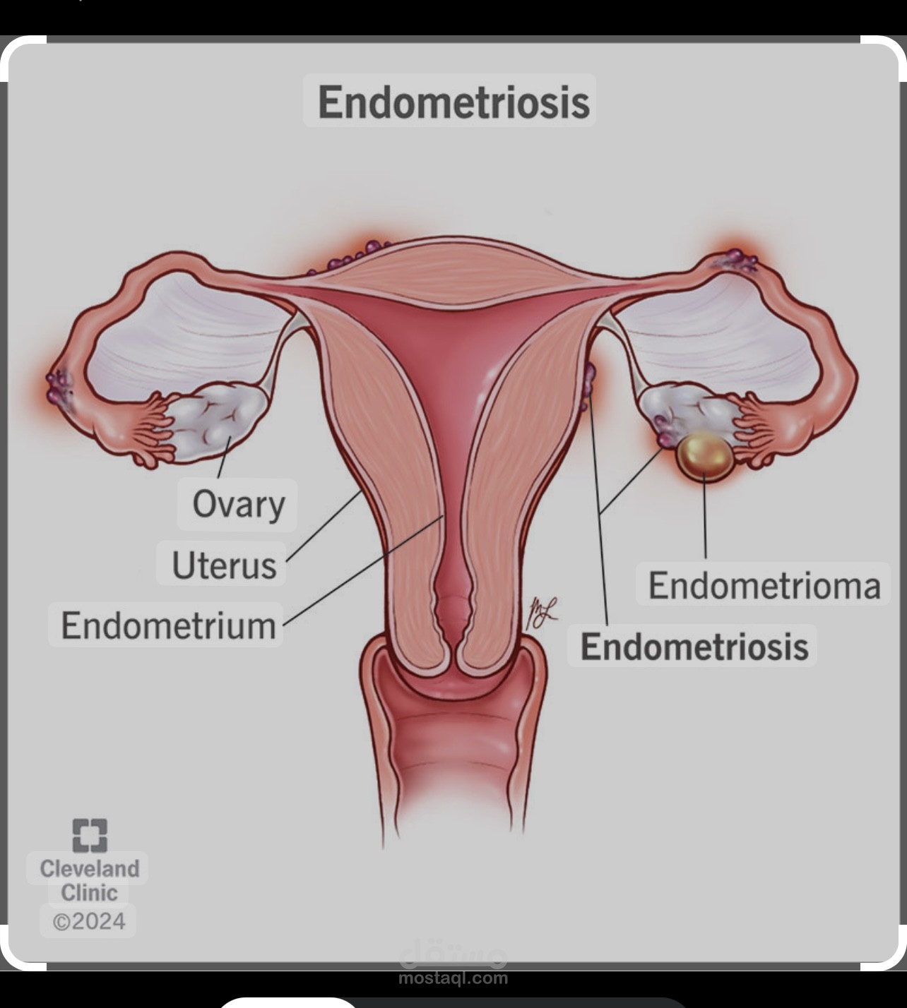 مقال طبي عن Endometriosis ( بطانة الرحم المهاجرة)