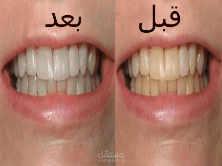تبيض الاسنان
