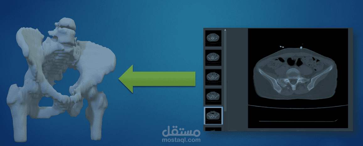 تحویل الصور  الطبية (رنين -طبقي محوري )إلى ملف ثلاثي البعد قابل للطباعة