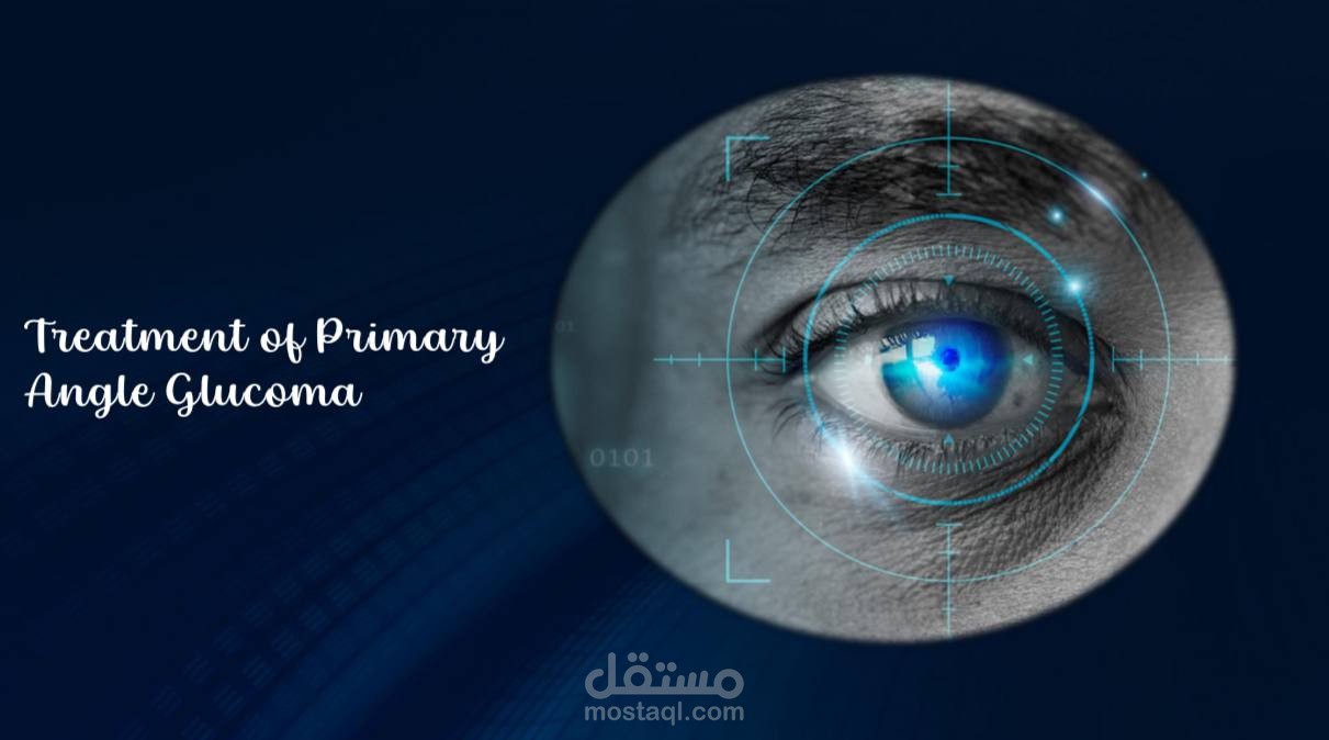 Treatment of primary angle glucoma