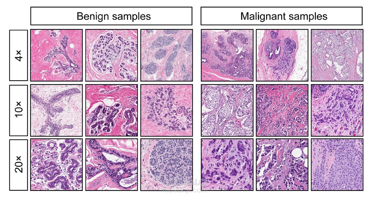 تحليل البيانات لسرطان الثدي