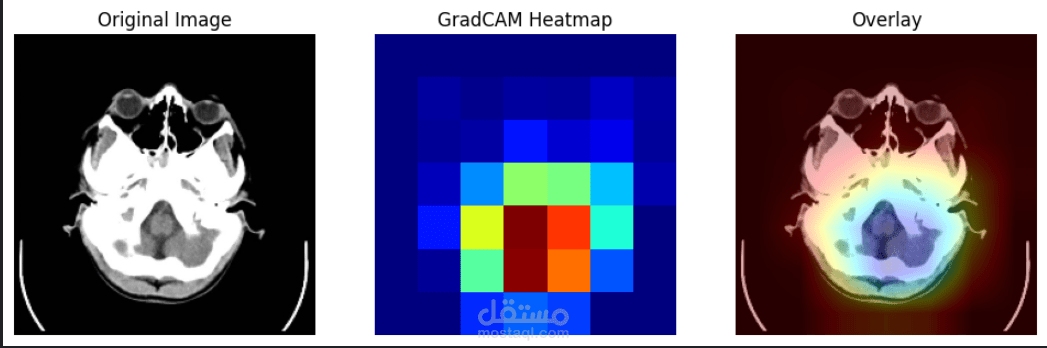 Master’s Project:  Deep Learning-Based Multiclass Classification of Brain Stroke Using CT and MRI Imaging